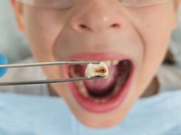 Best Emergency Treatment for Dental Infections or Abscesses in Anniston, AL